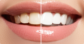 Безопасное отбеливание зубов Opalescence